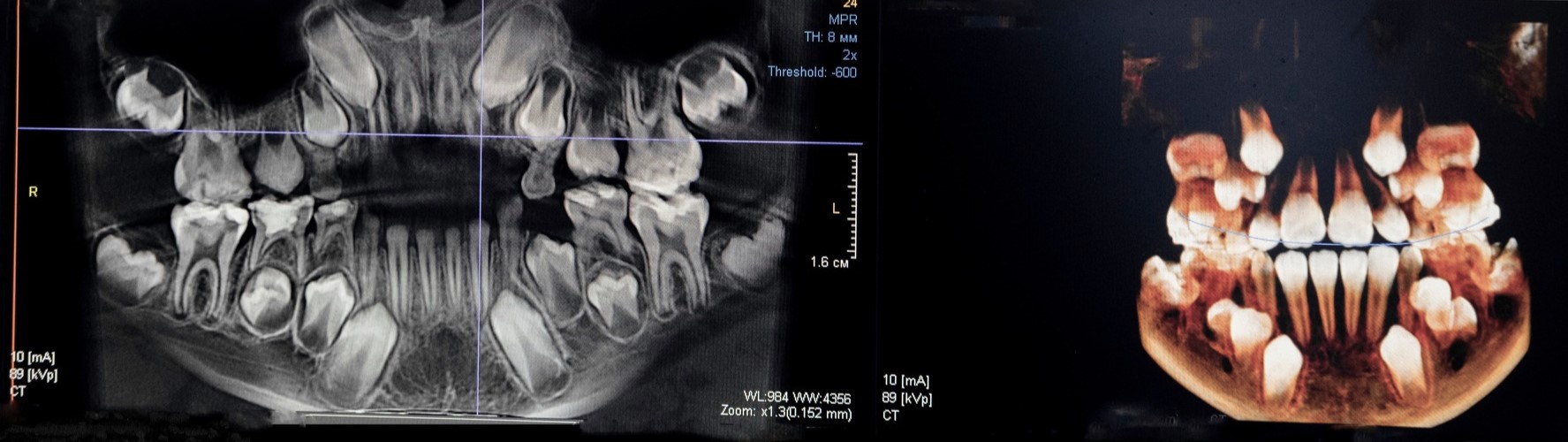 rentgen zębów, prześwietlenie zębów, pantogram zębów, zdjęcie zębów w Bielanach Wrocławskich w gabinecie dentystycznym Bielany Dental